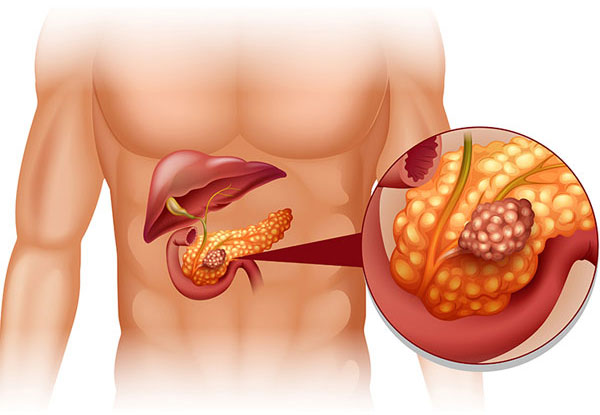 Your Intraductal Papillary Mucinous Neoplasm (IPMN)Requires Professional Management