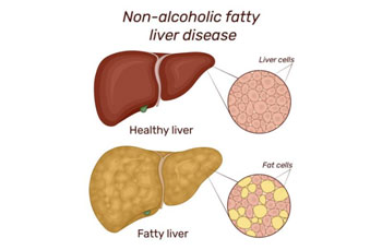 Understanding the fatty liver (NALFLD)