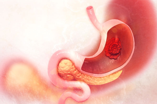 Stomach Cancer: How common it is?