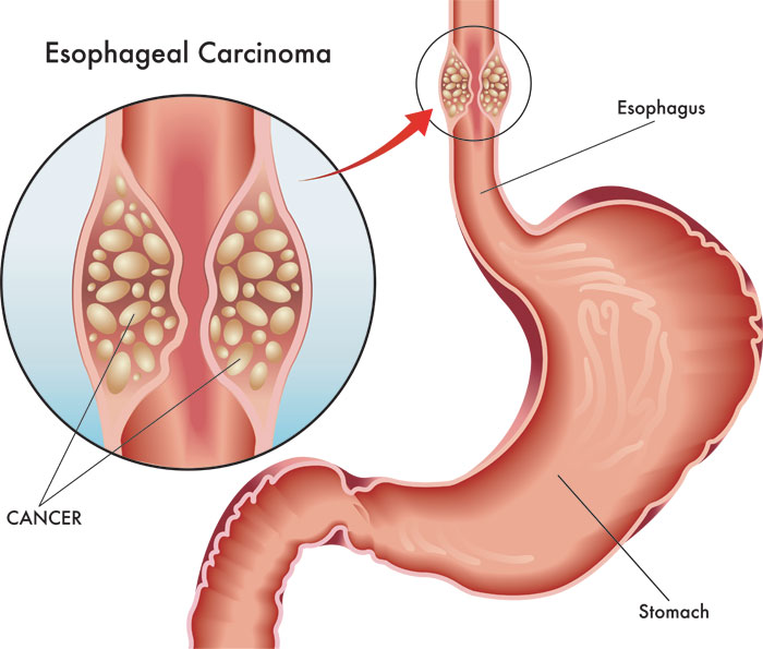 Understanding the Severity of Esophageal Cancer: One of the Deadliest Cancers
