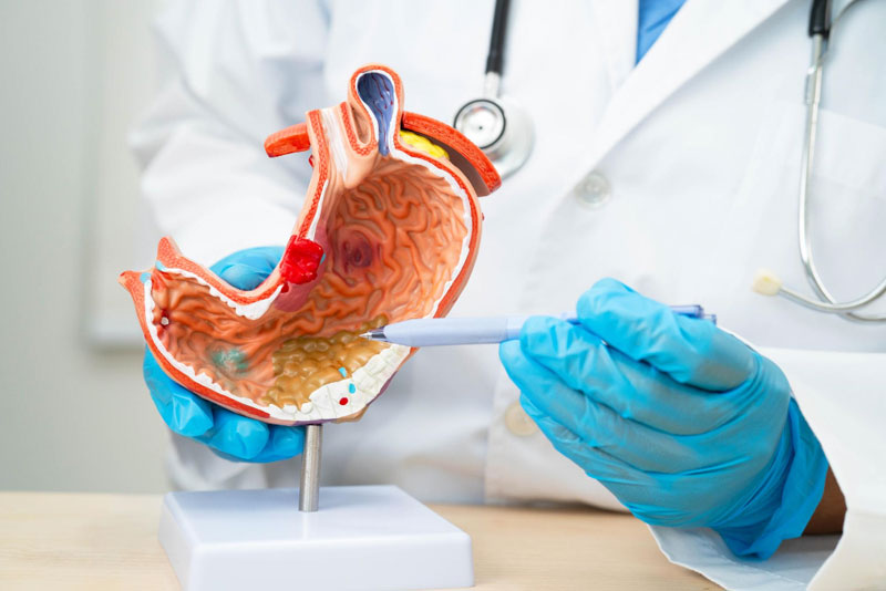 Hereditary Diffuse Gastric Cancer Treatment in Delhi: A Guide for Families with Genetic Risk