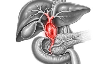 Benign Biliary Stricture