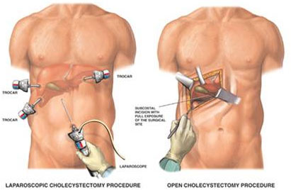 Laparoscopic cholecystectomy