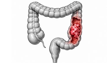 Colon Cancer