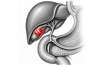 Gall Bladder Cancer