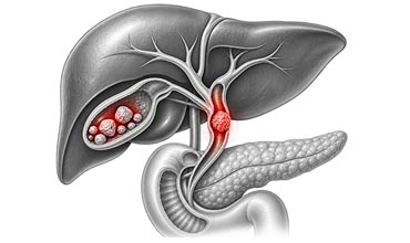 Gallstones And Bile Duct