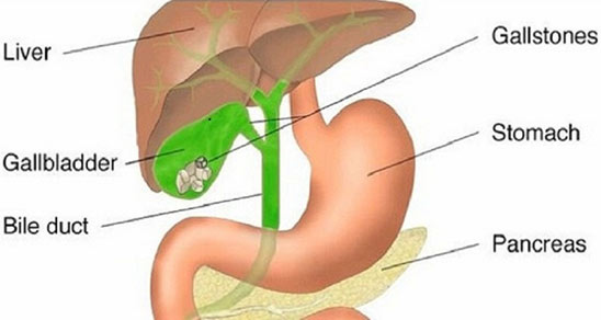 Gallbladder Stone Surgery In Delhi