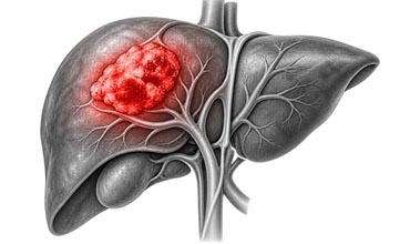Liver Cancer