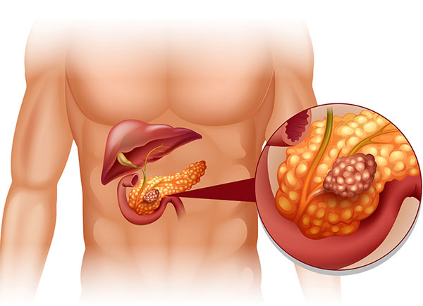 Pancreatic Treatment In Delhi