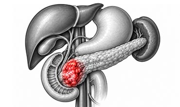 Pancreatic Cancer