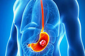 Stomach Cancer Treatment In Delhi