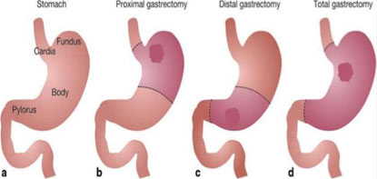 Stomach Cancer Treatment In Delhi